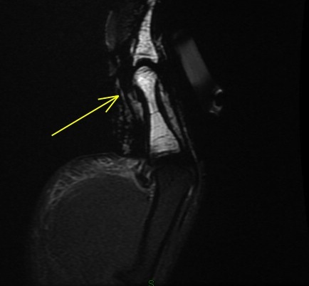 Figure 5 for case Flexor pollicis longus tendon ( RID2383 ) laceration